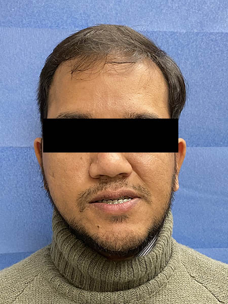 Picture of a man  before jaw surgery