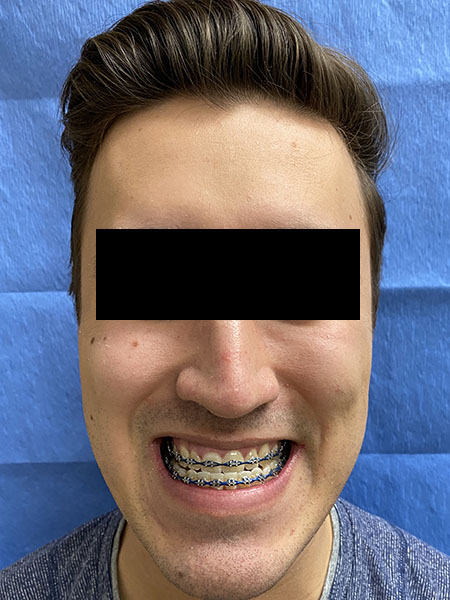Picture of a man  before jaw surgery