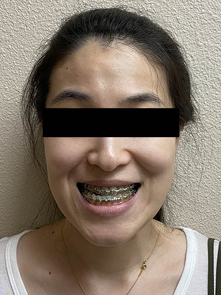 Picture of a woman  before jaw surgery