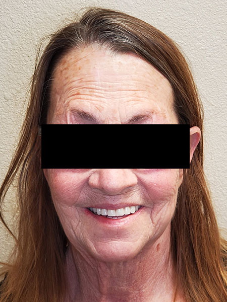 Picture of a woman  after jaw surgery