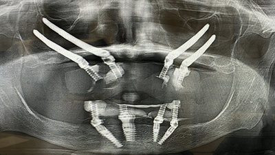 An Xray of all on 4 dental implants in patients mouth Surf City Oral and Maxillofacial Surgery in Huntington Beach, CA