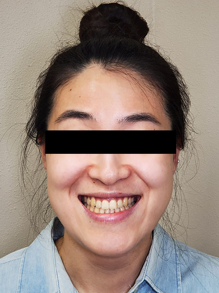 Picture of a woman  after jaw surgery