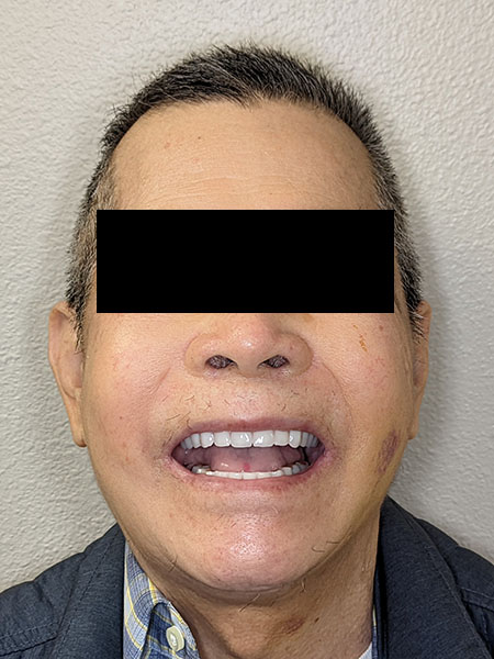 Picture of a man after jaw surgery