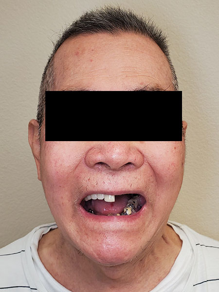 Picture of a man  before jaw surgery