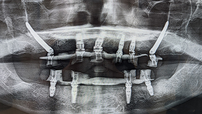 X-ray of a man after jaw surgery