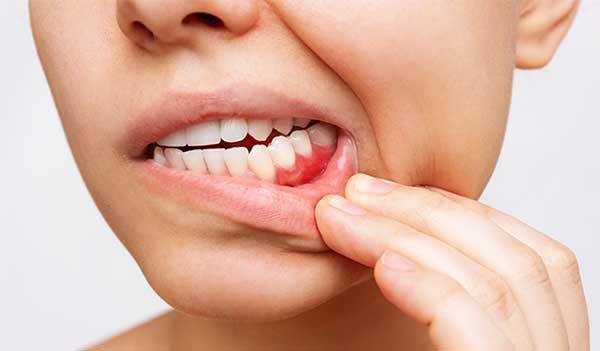 Woman pulling back cheek to show her teeth and gums