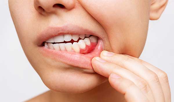 Woman with diabetes pulling back cheek to show her teeth and gum disease at Surf City Oral and Maxillofacial Surgery in Huntington Beach, CA