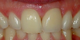 Picture of teeth after procedures