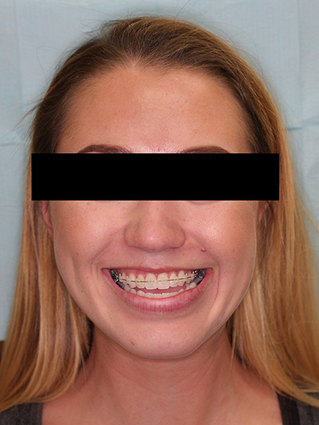 Picture of a woman  before jaw surgery