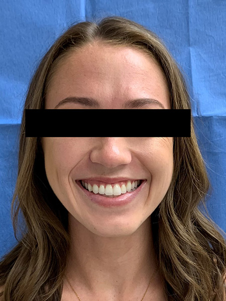 Picture of a woman  after jaw surgery