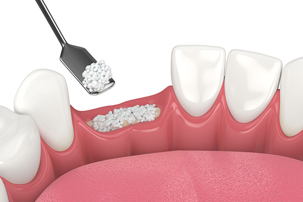 3D-renderring of a dental bone grafting procedure