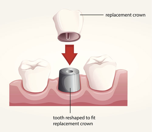 Illustration of dental crowns