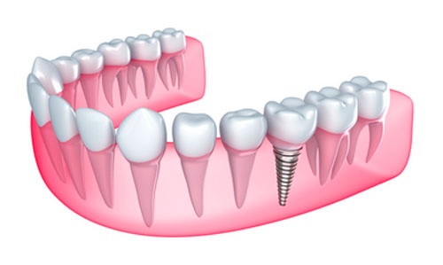 We Can Now Support Bridges with Implants