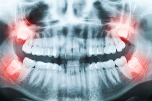 Xray of impacted wisdom teeth