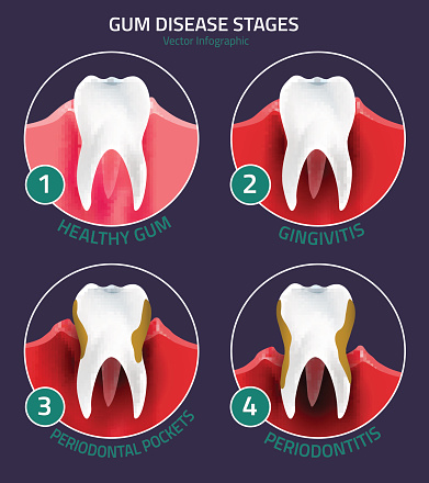 The stages of gum disease Huntington Beach, CA