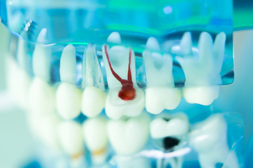 A model of a mouth with a tooth showing roots at Surf City Oral and Maxillofacial Surgery in Huntington Beach, CA