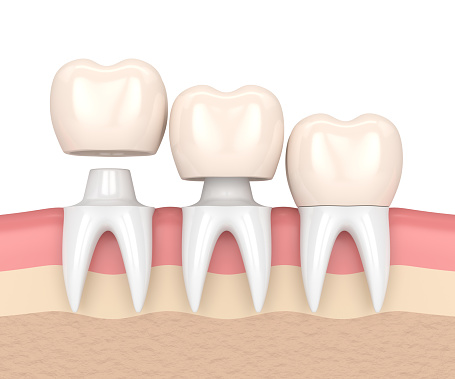 Illustration of  tooth getting a dental crown