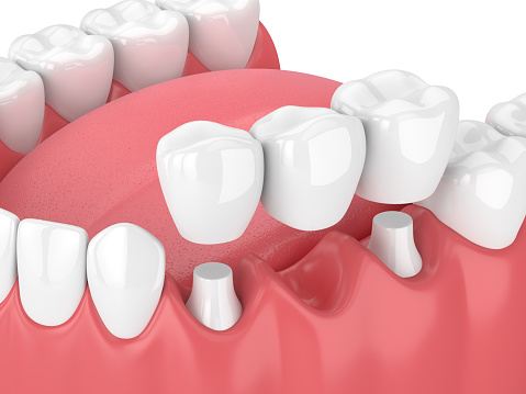 Illustration of jaw with dental bridge