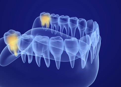 Illustration of jaw with wisdom teeth