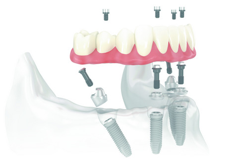 Diagram of All-on-4 Treatment Concept from Surf City Oral and Maxillofacial Surgery in Huntington Beach, CA