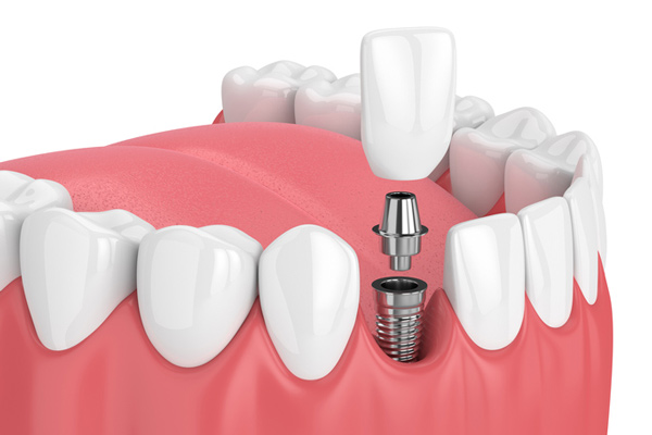 Diagram of a single dental implant from Surf City Oral and Maxillofacial Surgery in Huntington Beach, CA