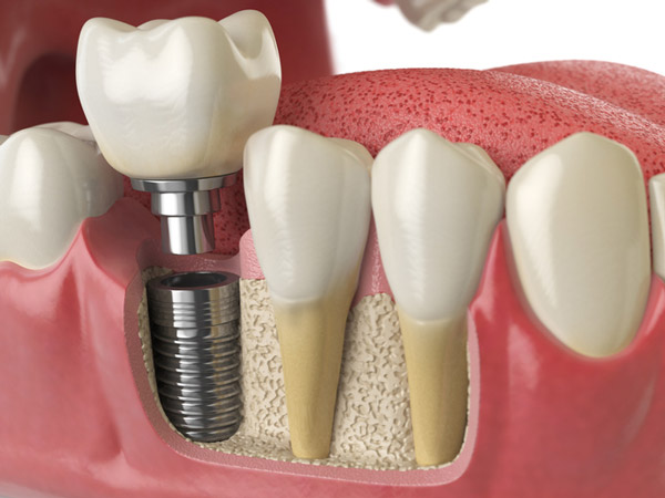 3D-rendered cross-section of a dental implant placed in to jaw bone