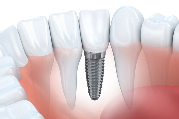 Diagram of dental implant in lower jaw from Surf City Oral and Maxillofacial Surgery in Huntington Beach, CA