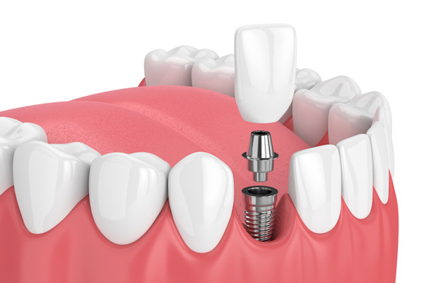 An implant placement diagram.