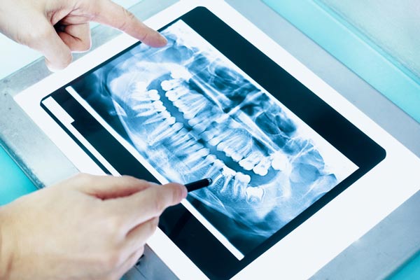 Dental x-ray of a full mouth used for a full mouth restoration procedure at Surf City Oral and Maxillofacial Surgery in Huntington Beach, CA