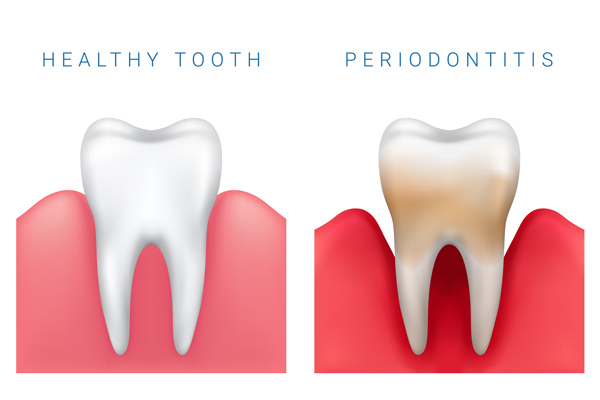 Illustration of a healthy tooth and a tooth with periodontitis at Surf City Oral and Maxillofacial Surgery in Huntington Beach, CA
