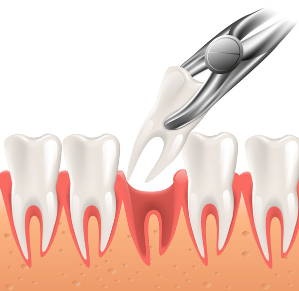 Illustration of a tooth being extracted at Surf City Oral and Maxillofacial Surgery in Huntington Beach, CA
