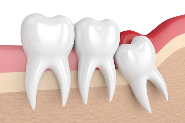 Illustration of an impacted wisdom tooth at Surf City Oral and Maxillofacial Surgery in Huntington Beach, CA