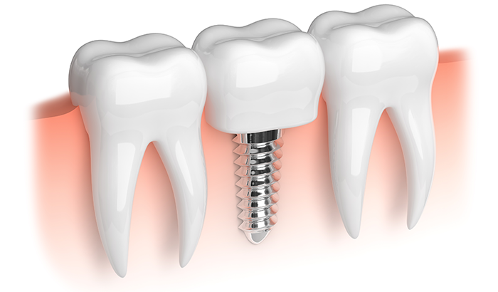 Close up diagram of two teeth and a dental implant